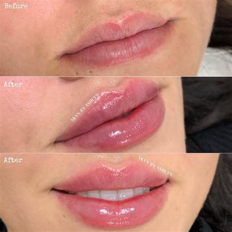 can you put makeup on after fillers  The lip filler injection holes will close in a matter of minutes, but waiting an hour will assure that no infection arises from entry into